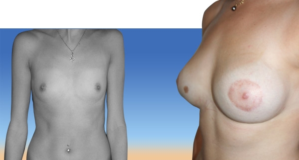 Augmentation mammaire avant / après